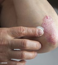 Psoriasis