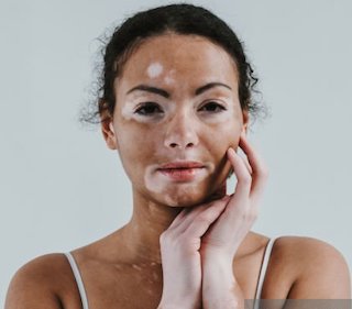 Reverse vitiligo