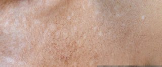 Skin discolouration